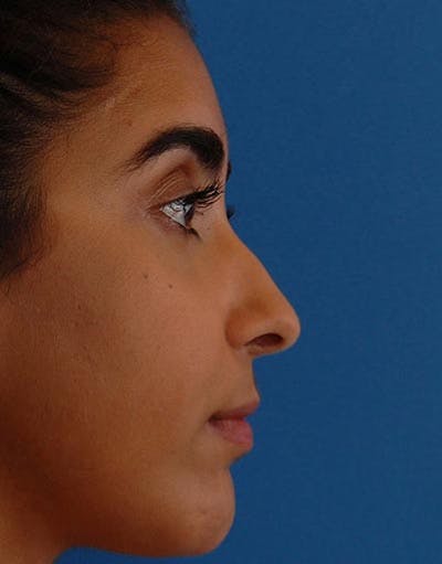 Favorite Ethnic Rhinoplasty Before & After Gallery - Patient 229022 - Image 1