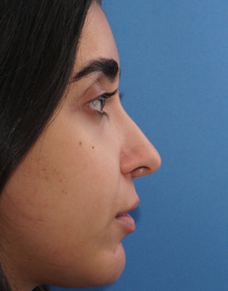 Rhinoplasty Before & After Gallery - Patient 649993 - Image 2
