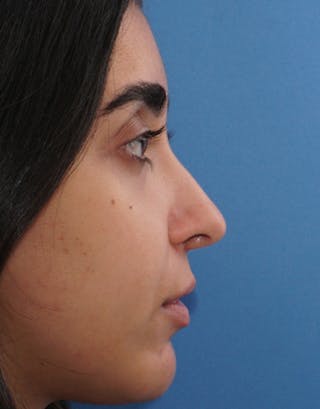 Favorite Ethnic Rhinoplasty Before & After Gallery - Patient 229022 - Image 2