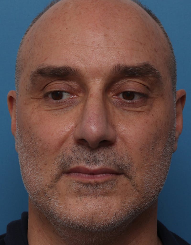 Rhinoplasty  Before & After Gallery - Patient 301040 - Image 4