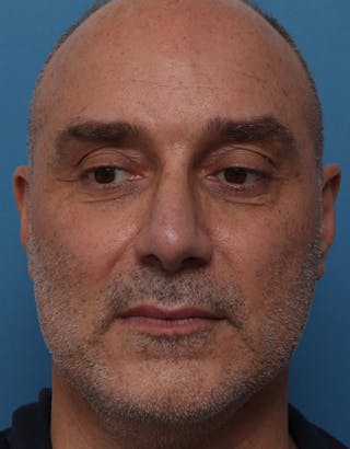 Rhinoplasty Before & After Gallery - Patient 301040 - Image 4