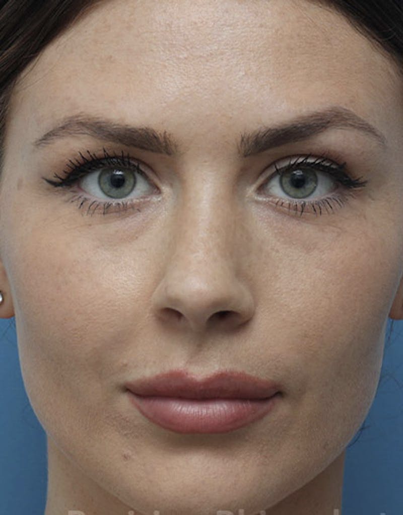 Revision Rhinoplasty Before & After Gallery - Patient 149031 - Image 4