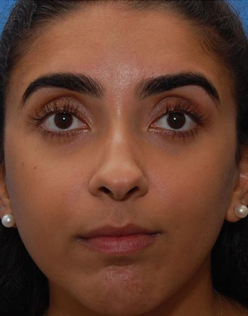 Rhinoplasty  Before & After Gallery - Patient 202312 - Image 3