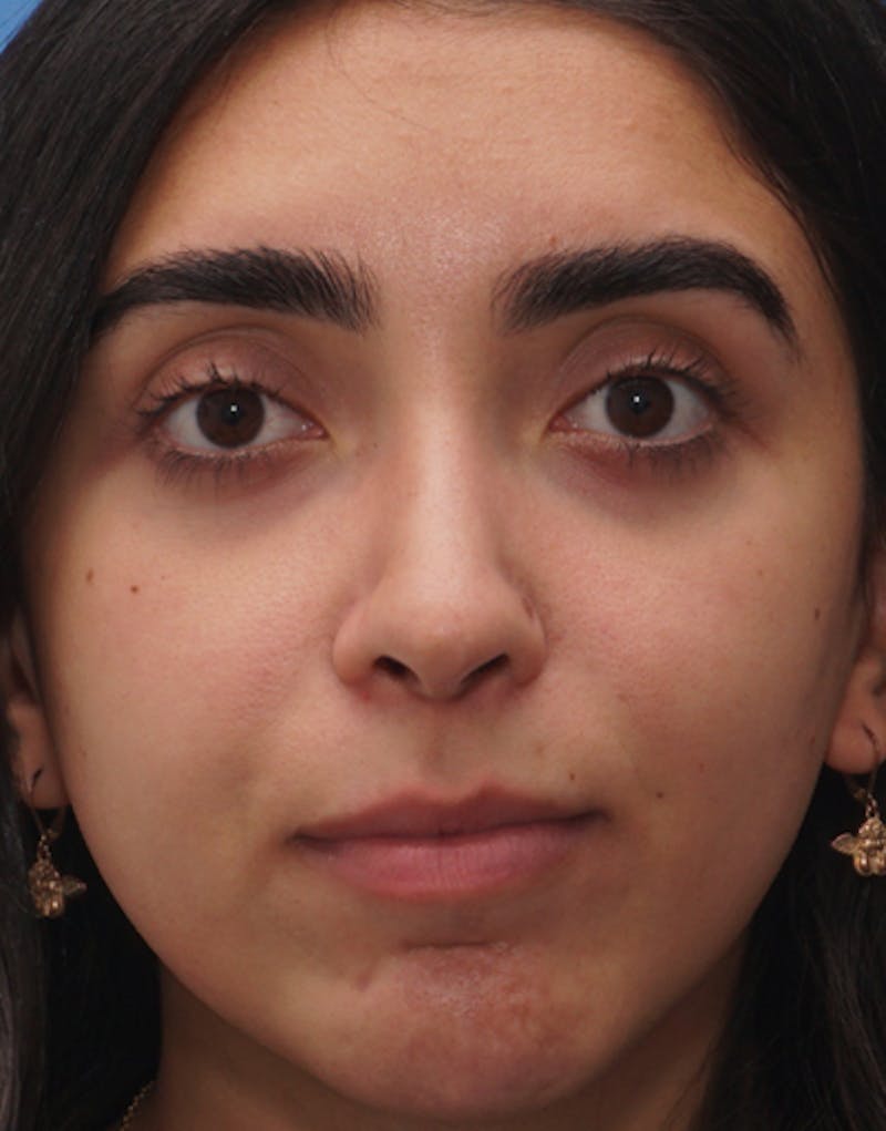 Rhinoplasty  Before & After Gallery - Patient 202312 - Image 4