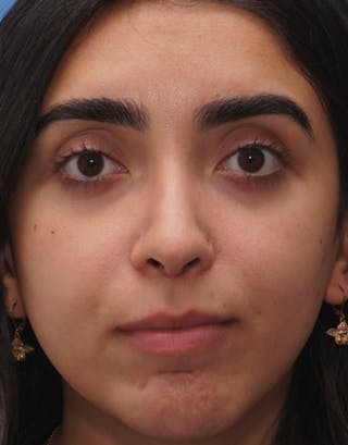 Favorite Ethnic Rhinoplasty Before & After Gallery - Patient 229022 - Image 4