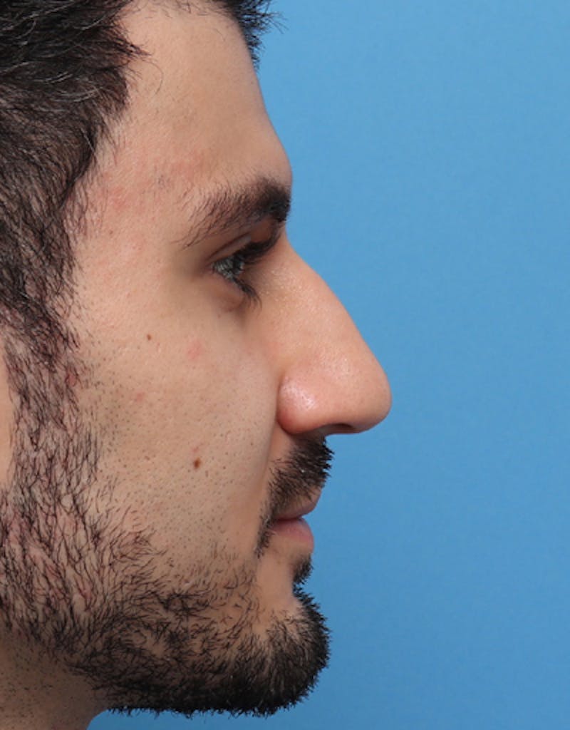 Patient E_NcaXhtRnWDhHnt6sUC_w - Male Rhinoplasty Before & After Photos