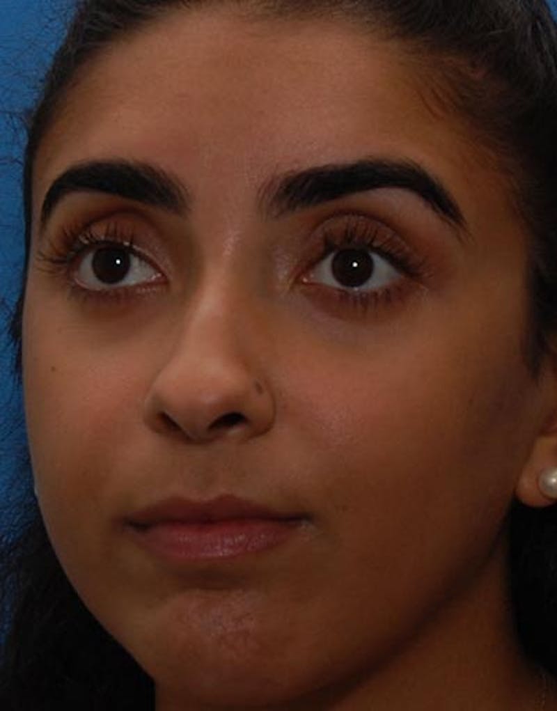 Rhinoplasty Before & After Gallery - Patient 649993 - Image 5