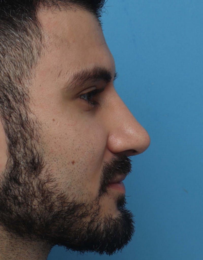 Male Rhinoplasty Before & After Gallery - Patient 736794 - Image 2