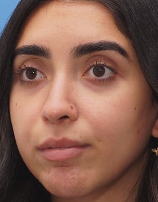 Favorite Ethnic Rhinoplasty Before & After Gallery - Patient 229022 - Image 6