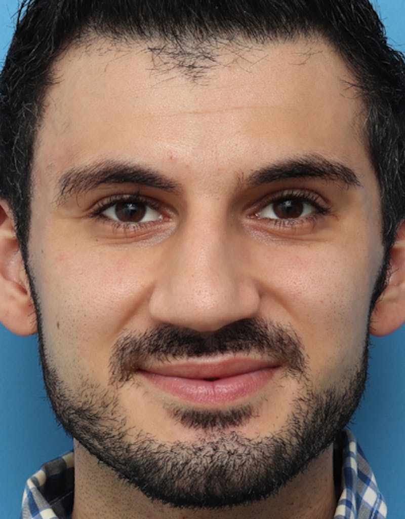 Favorite Male Rhinoplasty Before & After Gallery - Patient 182605 - Image 3