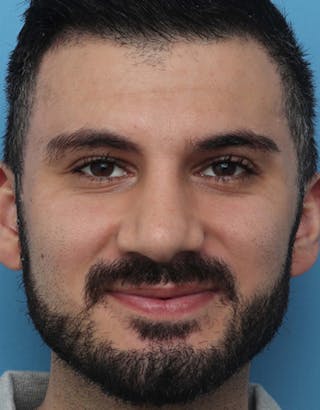 Favorite Male Rhinoplasty Before & After Gallery - Patient 182605 - Image 4