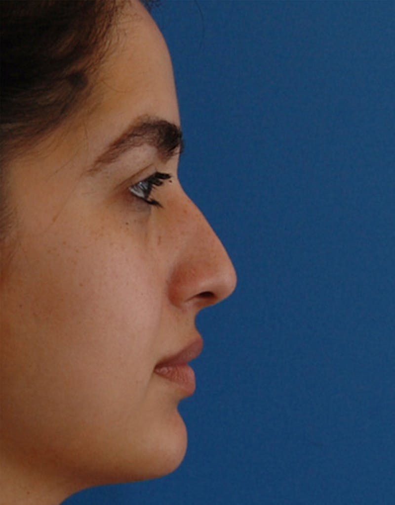 Rhinoplasty Before & After Gallery - Patient 635259 - Image 1
