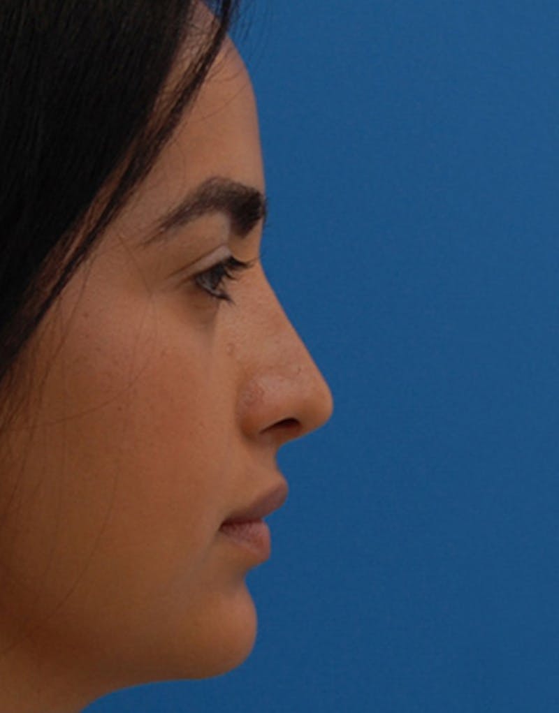 Rhinoplasty Before & After Gallery - Patient 635259 - Image 2