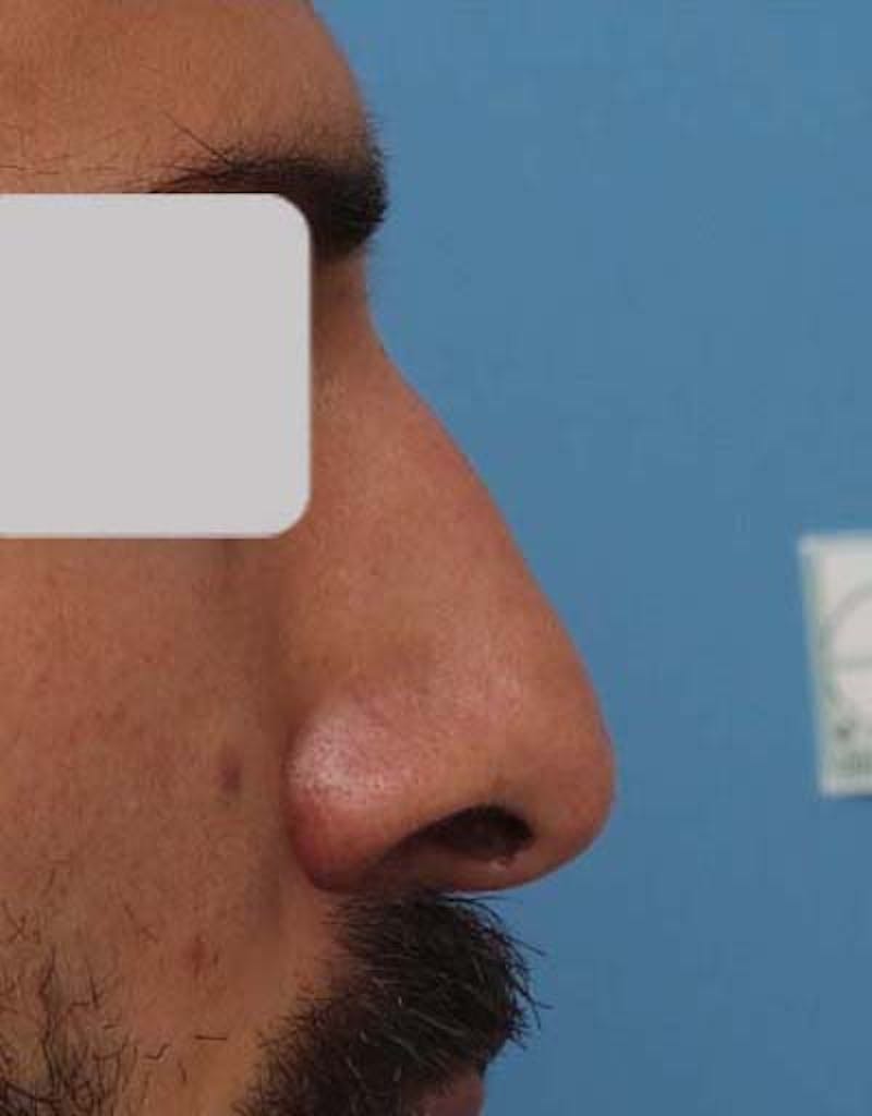 Patient XdMOSjICTD-9hPxt2K9LIQ - Male Rhinoplasty Before & After Photos