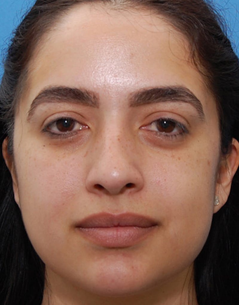 Rhinoplasty Before & After Gallery - Patient 635259 - Image 3