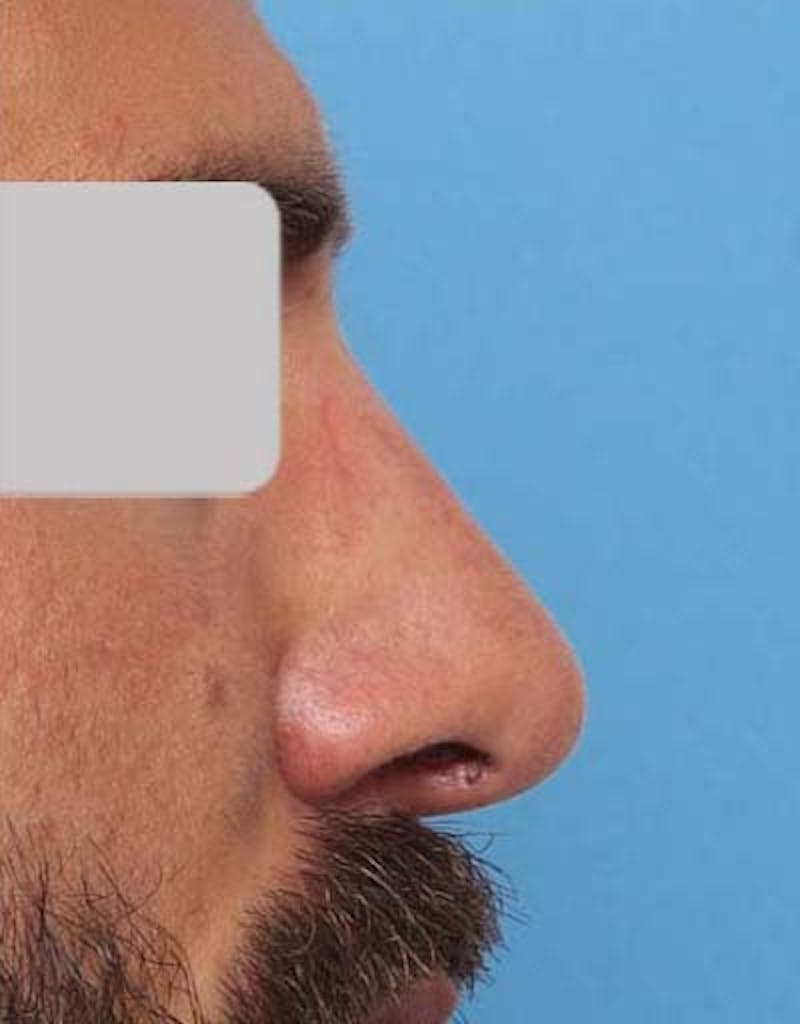 Male Rhinoplasty Before & After Gallery - Patient 392245 - Image 2