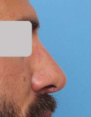 Favorite Revision Rhinoplasty Before & After Gallery - Patient 119491 - Image 2