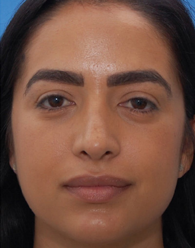 Rhinoplasty Before & After Gallery - Patient 635259 - Image 4