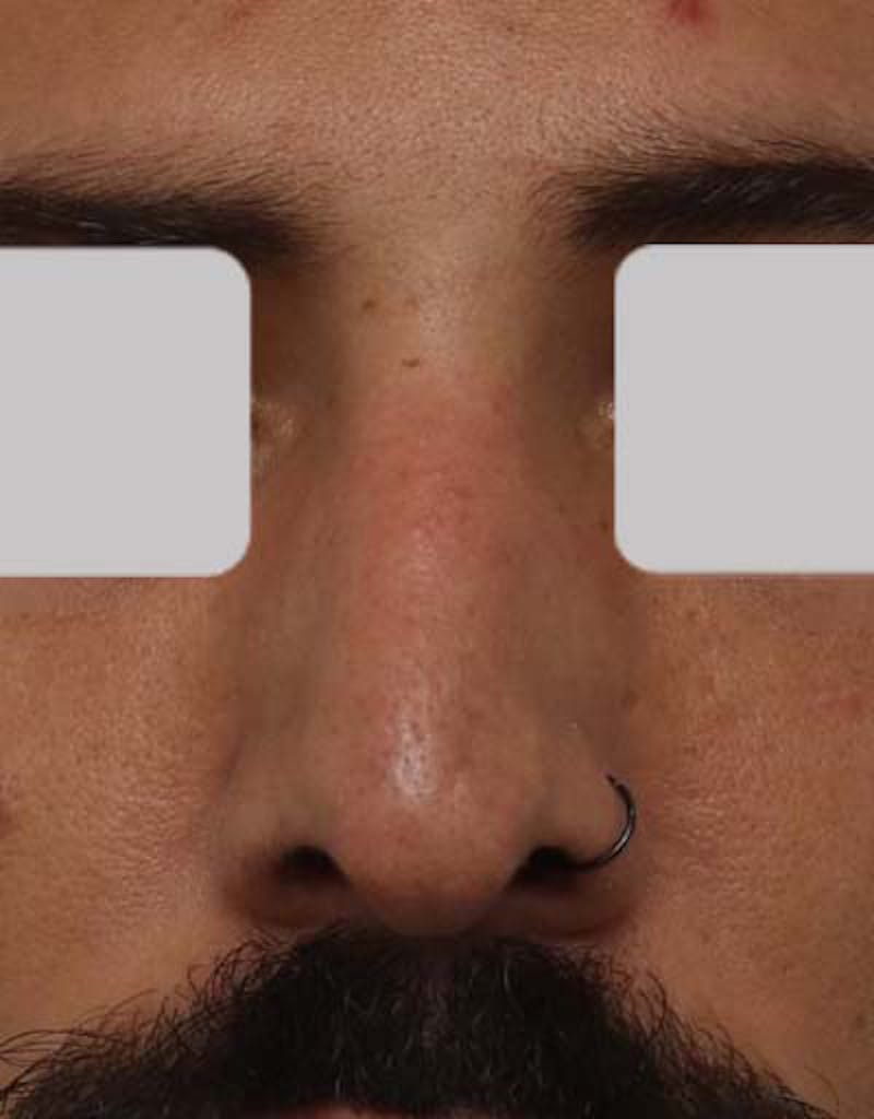 Male Rhinoplasty Before & After Gallery - Patient 392245 - Image 3