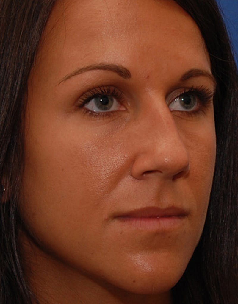 Rhinoplasty Before & After Gallery - Patient 635259 - Image 5