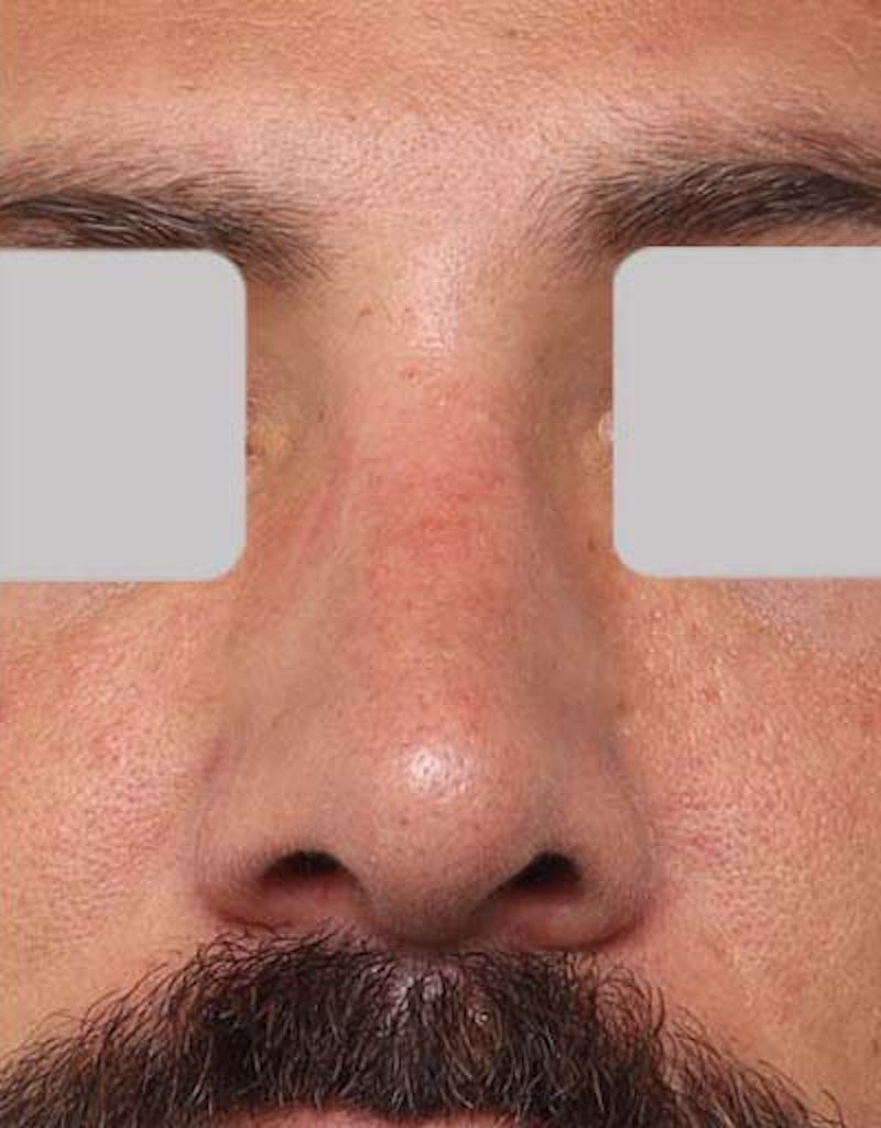 Male Rhinoplasty Before & After Gallery - Patient 392245 - Image 4