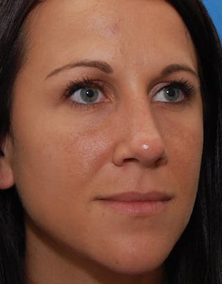 Rhinoplasty Before & After Gallery - Patient 151830 - Image 4