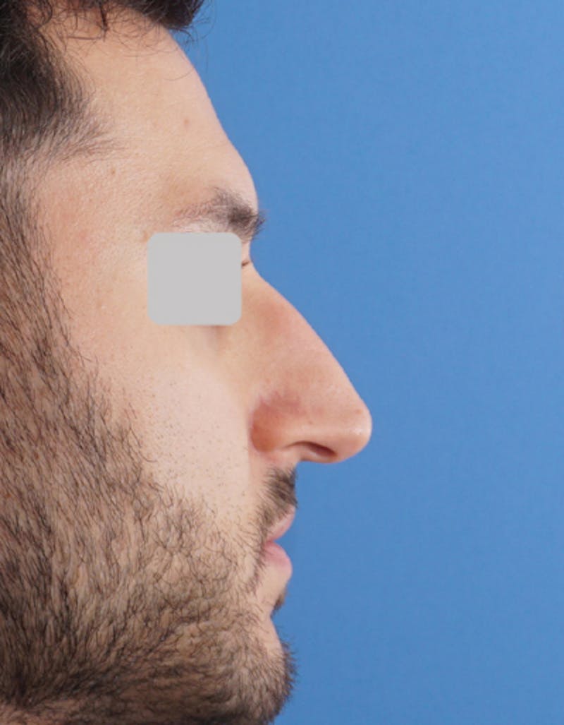 Male Rhinoplasty Before & After Gallery - Patient 345415 - Image 1