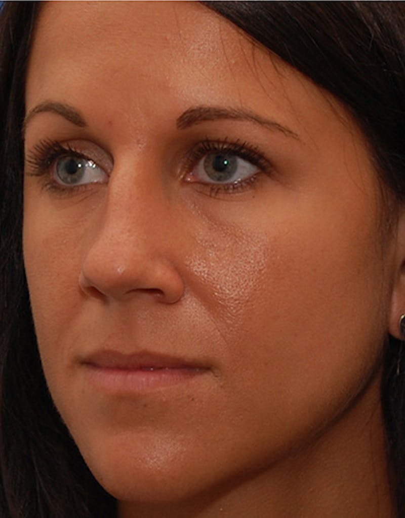 Rhinoplasty Before & After Gallery - Patient 635259 - Image 7