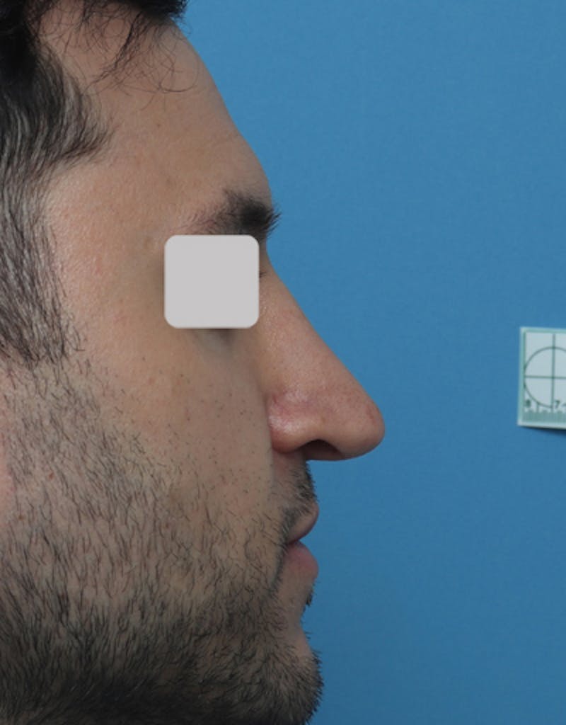 Male Rhinoplasty Before & After Gallery - Patient 345415 - Image 2