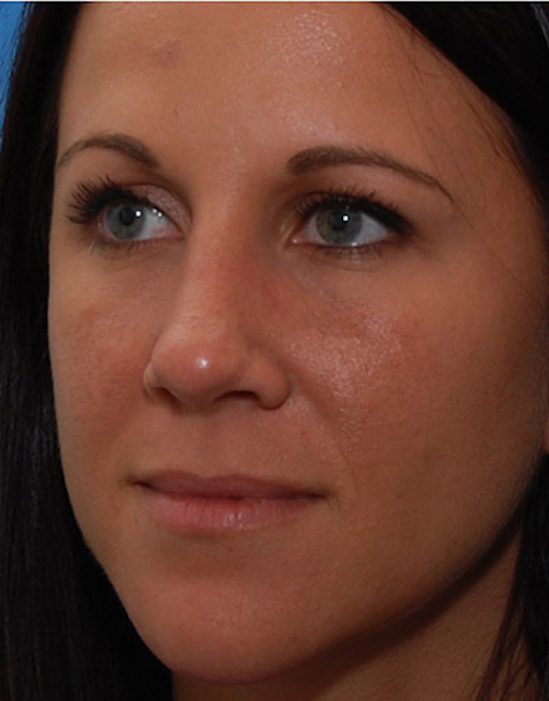 Rhinoplasty Before & After Gallery - Patient 635259 - Image 8