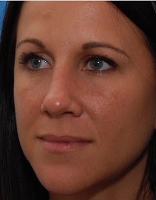 Rhinoplasty Before & After Gallery - Patient 151830 - Image 6