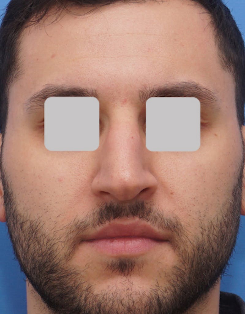 Male Rhinoplasty Before & After Gallery - Patient 345415 - Image 3