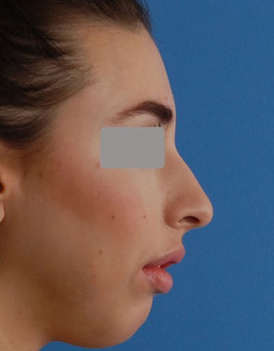 Rhinoplasty Before & After Gallery - Patient 318643 - Image 1