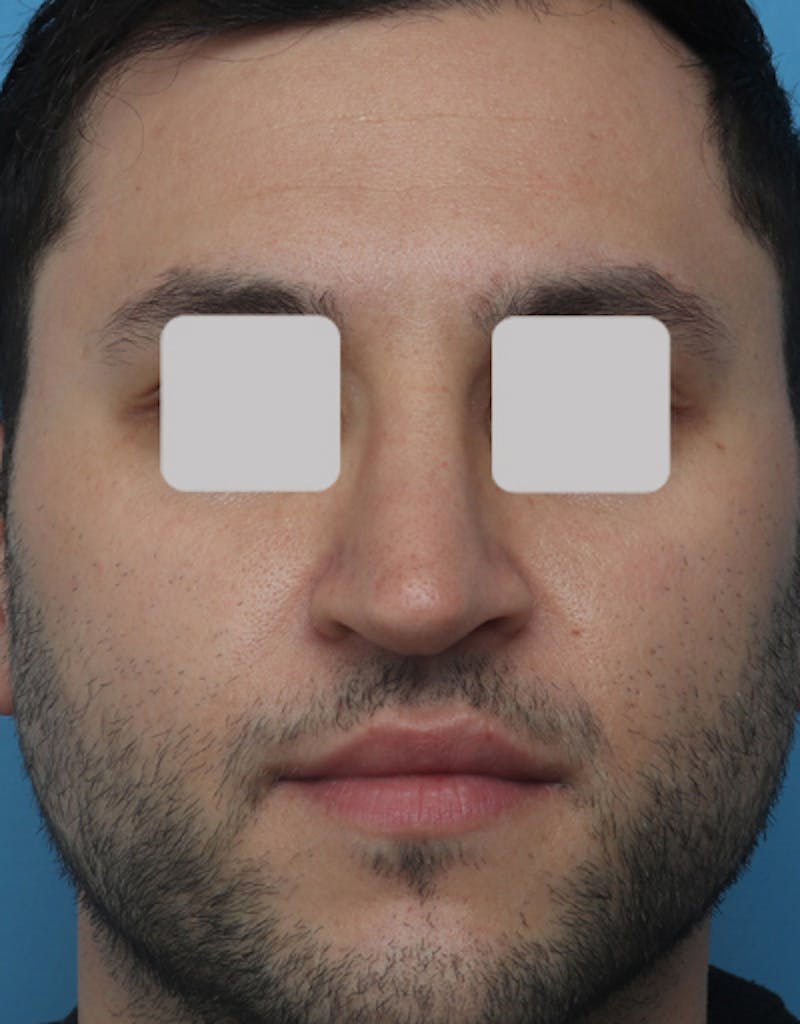 Rhinoplasty  Before & After Gallery - Patient 546282 - Image 4
