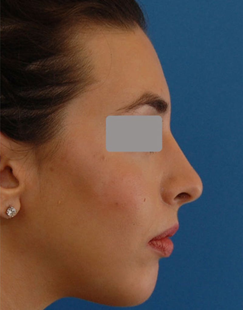 Rhinoplasty Before & After Gallery - Patient 626780 - Image 2