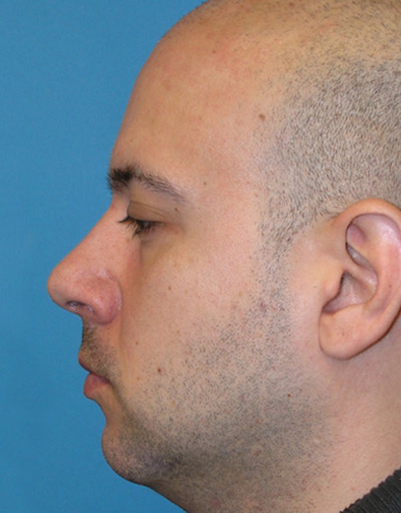 Male Rhinoplasty Before & After Gallery - Patient 339119 - Image 1