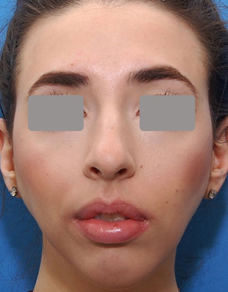 Rhinoplasty Before & After Gallery - Patient 626780 - Image 3