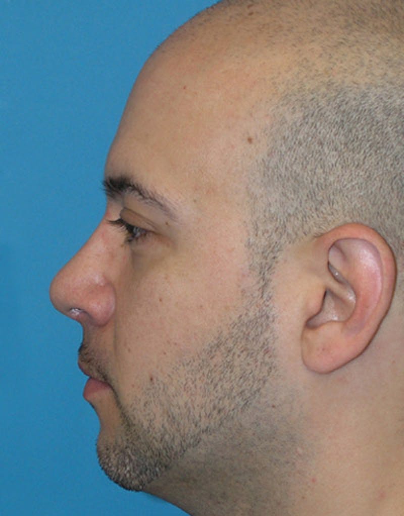 Male Rhinoplasty Before & After Gallery - Patient 339119 - Image 2