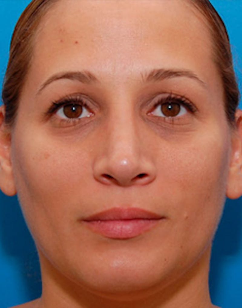 Rhinoplasty Before & After Gallery - Patient 626780 - Image 4