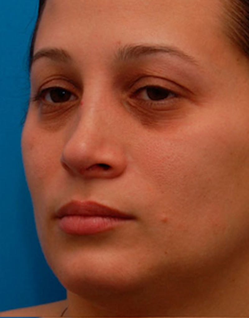Rhinoplasty Before & After Gallery - Patient 626780 - Image 5