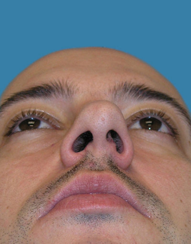 Male Rhinoplasty Before & After Gallery - Patient 339119 - Image 7