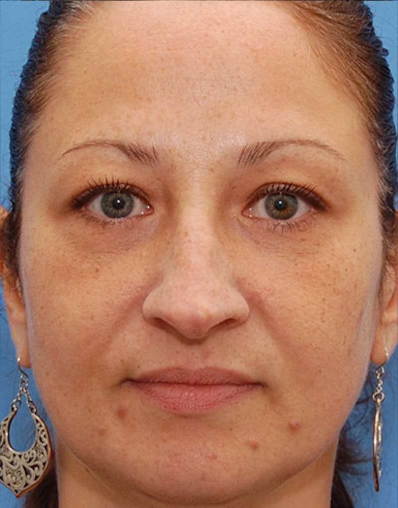 Rhinoplasty Before & After Gallery - Patient 881585 - Image 5
