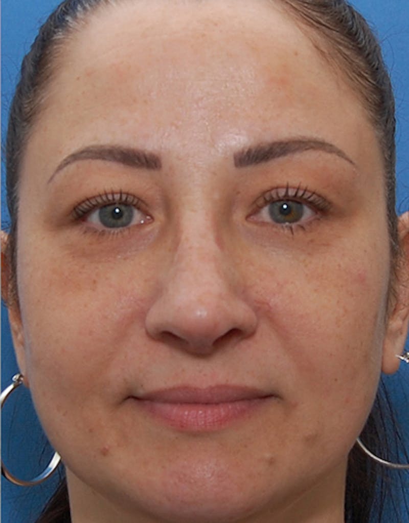 Rhinoplasty Before & After Gallery - Patient 881585 - Image 6