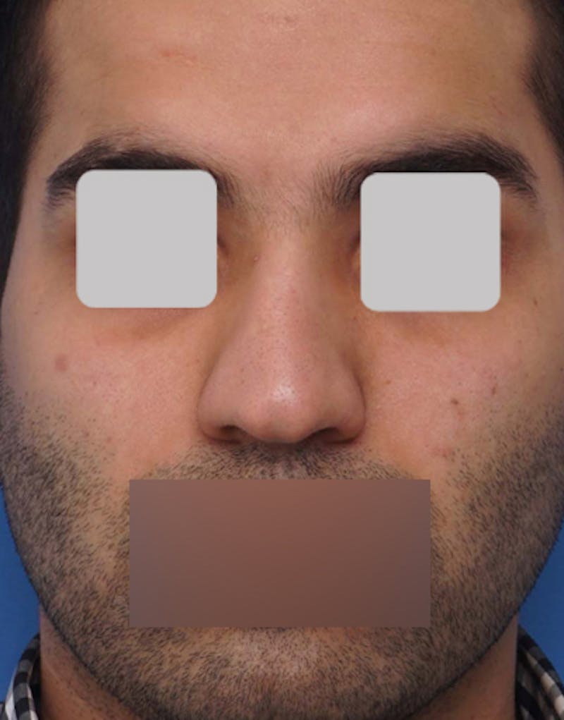 Male Rhinoplasty Before & After Gallery - Patient 795892 - Image 1