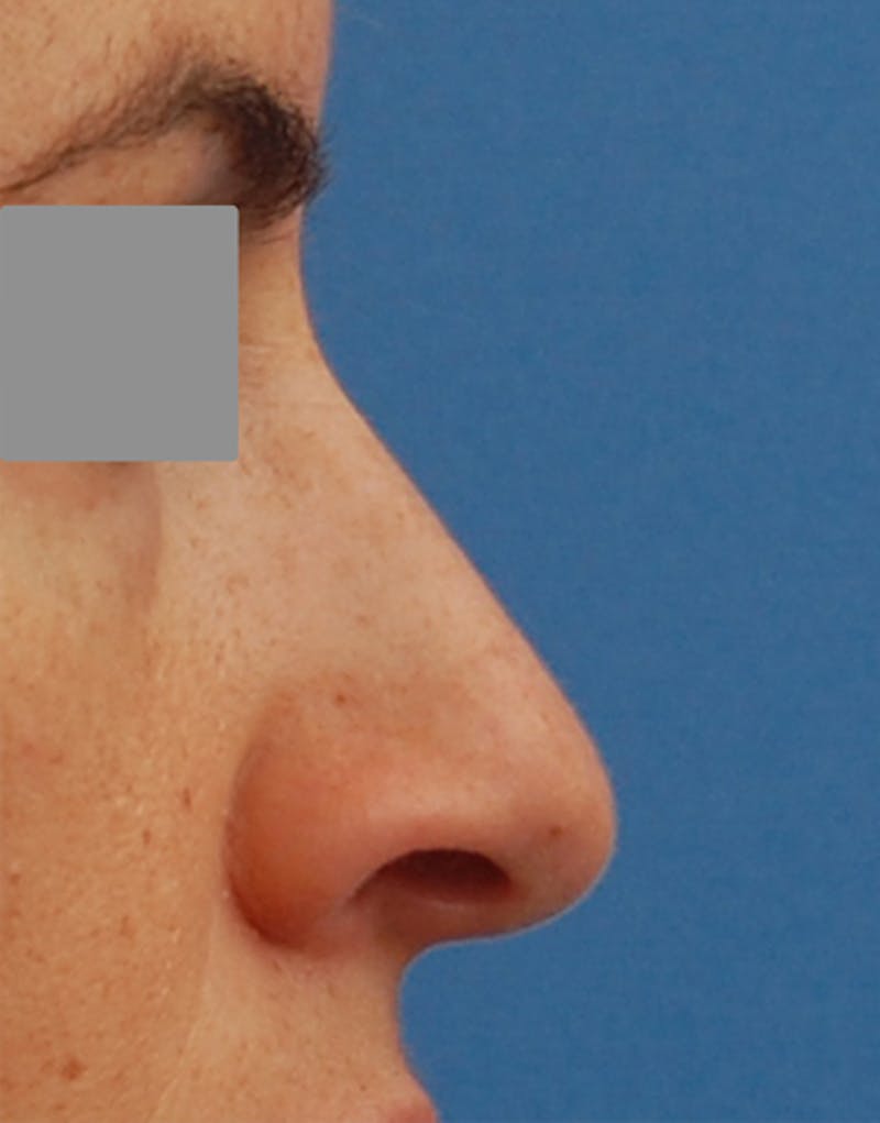 Rhinoplasty Before & After Gallery - Patient 101069 - Image 1