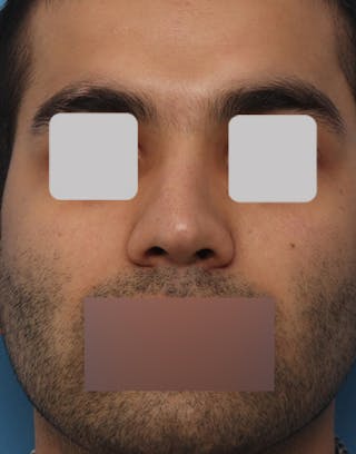 Rhinoplasty Before & After Gallery - Patient 366683 - Image 2