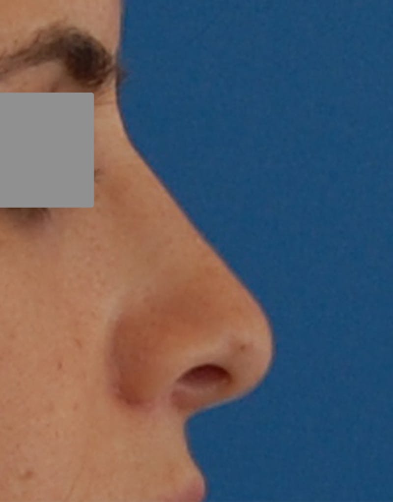 Rhinoplasty Before & After Gallery - Patient 101069 - Image 2