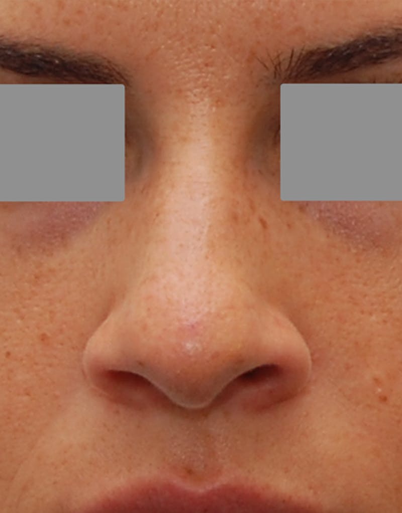 Rhinoplasty Before & After Gallery - Patient 101069 - Image 3
