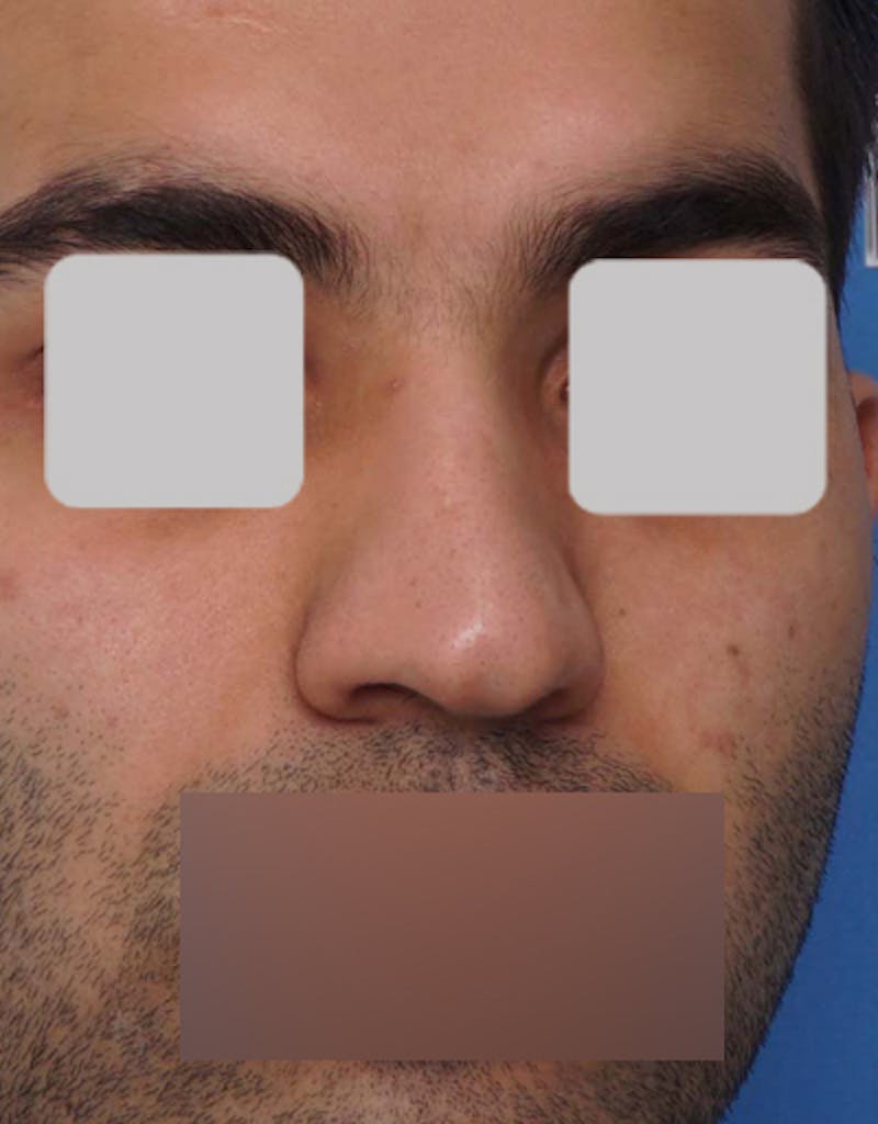Male Rhinoplasty Before & After Gallery - Patient 795892 - Image 3