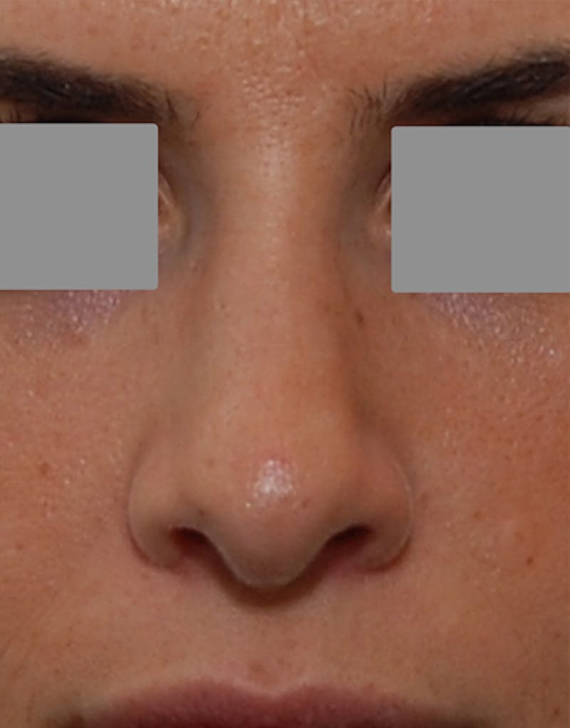 Rhinoplasty Before & After Gallery - Patient 101069 - Image 4